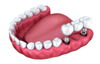 Tooth Replacement Indian Land SC, Indian Land, SC