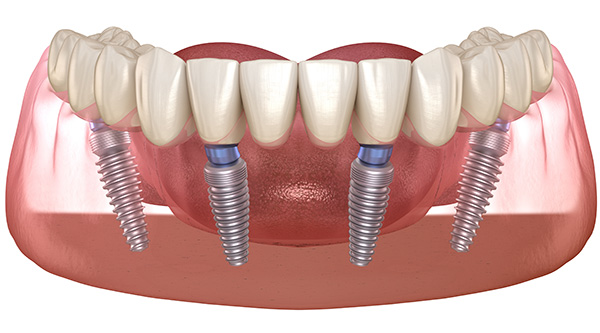 all on 4 dental implants